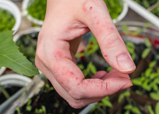 Poison Ivy Rash on Hand